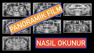 Panoramik Film Nasıl Okunur ?