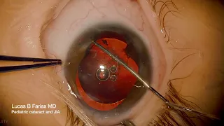 Pediatric Cataract Secondary to JIA-related Uveitis