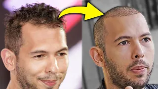 I Cracked Andrew Tate's Hair Transplant Secret!