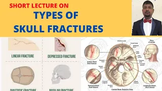 SKULL FRACTURE TYPES/ HEAD INJURIES