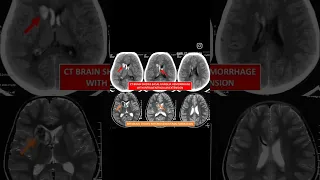 Brain hemorrhage with intraventricular hemorrhage #shorts #viral #shortsvideo