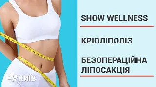 Кріоліполіз: швидке схуднення без хірургічного втручання #ShowWellness