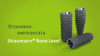 Установка имплантата: Straumann® Bone Level