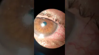 Metallic Corneal Foreign Body