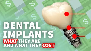 💰 Dental Implants • What They Are and How Much Implants Cost 💰