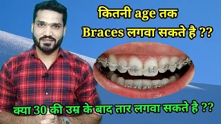 किस उम्र तक ब्रेसेस लगवा सकते है ?? Age limit for Braces treatment ?