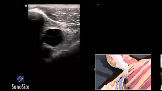 How To: Ultrasound Guided Insertion of a Subclavian Vein Catheter 3D Video