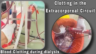 Blood Clotting During Hemodialysis | Clotting In the Extracorporeal circuit