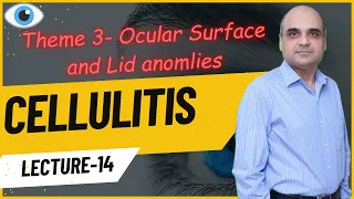 Cellulitis Lecture 14