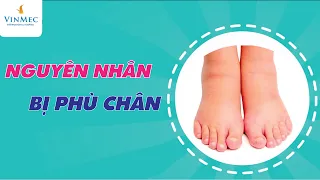 Vì sao bạn bị phù chân? Làm sao cho hết?