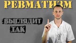 Осложнение ревматизма