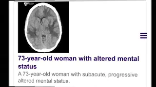 Cerebral amyloid angiopathy (CAA)