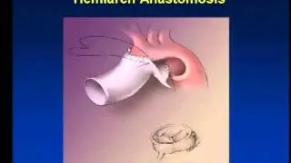 Thoracic and Thoracoabominal Aortic Aneurysm- Dr. Alberto Pochettino, 9/18/13