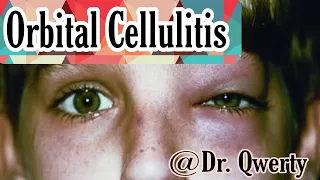 Orbital Cellulitis | Clearly explained | Ophthalmology | MBBS | Dr. Qwerty