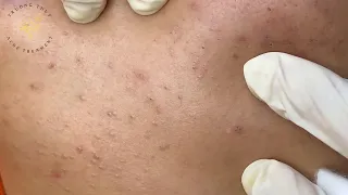 Acne Treament Under The Skin #035