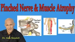 Pinched Nerve and Muscle Atrophy (What You Should Understand) - Dr Mandell