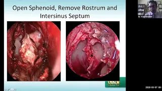 Endoscopic approaches to the skull base - Dr. Arjun Parasher