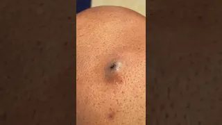 The best acne video 2021