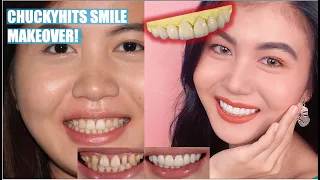 Chuckyhits No Veneers Veneers Look | Emax Porcelain Veneers Procedure | Apostol Dental Philippines