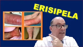 TRATAMENTO DA ERISIPELA