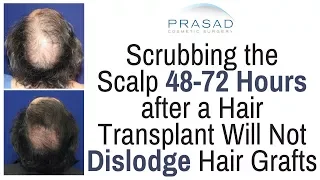 When Transplanted Hair Grafts are Secure Enough to Allow Scalp Cleaning and Scrubbing