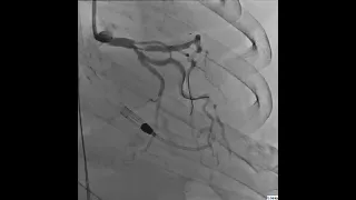 Coronary Angiogram post PTCA with Suboptimal Results