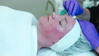 Instructional Video - Professional Jessner's Peel Solution