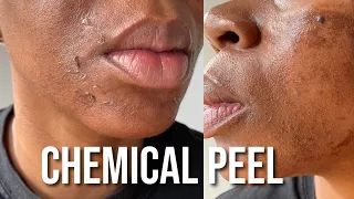 My PCA Chemical Peel for Hyperpigmentation and Texture