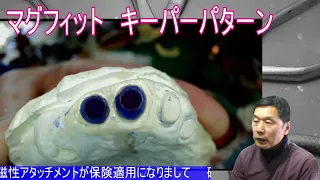 保険適用になった磁性アタッチメントのキーパー製作