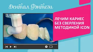 🦷 Лечим кариес без сверления методикой ICON