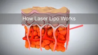 How Laser Lipo Works to Release Fat and Reduce Cellulite
