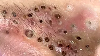 Blackheads removal 1745