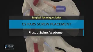 Surgical Techniques: C2 Pars Screw Placement