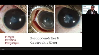 Lecture: Microbial Keratitis: Update for General Ophthalmologists