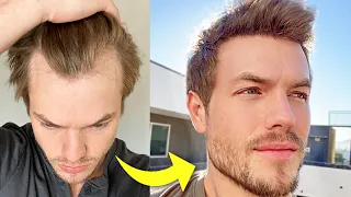 My Turkey Hair Transplant 4 Month Update | Before & After