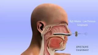 Epistaxis Treatment - 3D