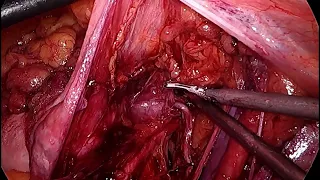 Open Radical #hysterectomy for #cancer cervix stage IB1