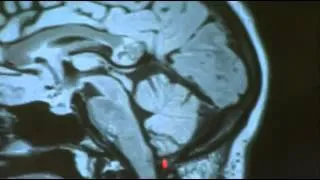 Embryonic twin discovered in woman's brain