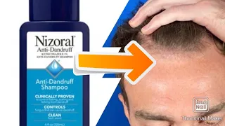 Should you use Ketoconazole Shampoo for Hair Loss!? (Featuring Steve Cook)