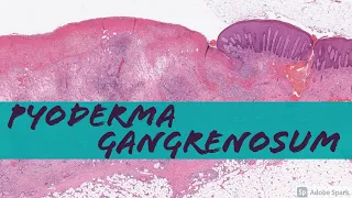 Pyoderma Gangrenosum (vs Non-Specific Chronic Ulcer Changes)