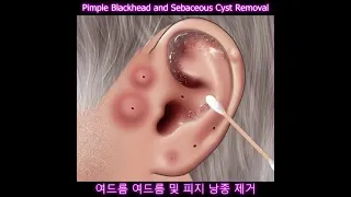 Pimple Blackhead and Sebaceous Cyst Removal | 2D Animation