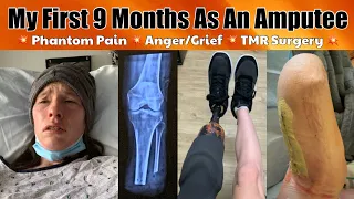 My Amputee Journey Thus Far: 9 Months Post-Amputation