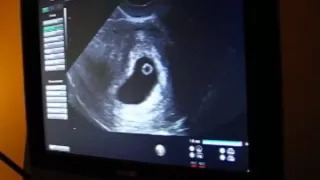 First Ultrasound at 6 weeks 3 days