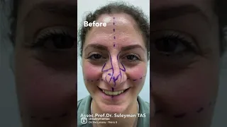 Crooked Nose Correction | Before & 7 Days After | Straightening Symmetry ✨