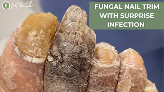 FUNGAL NAIL TRIM WITH SURPRISE INFECTION PART 1