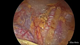 Laparoscopic dissection of the pararectal space for beginners