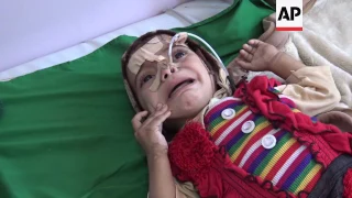 Yemeni children suffering from malnutrition