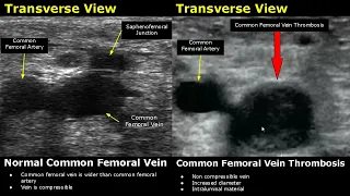 Femoral Vein Doppler Ultrasound Normal Vs Abnormal Image Appearances | Deep Vein Thrombosis USG Scan