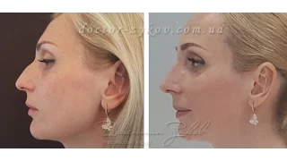 Rhinoplasty with osteotomy - before and after the 8th day