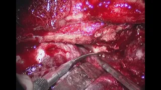 Orbitotomy, orbitopterional, OZ with clinoidectomy..step by step,